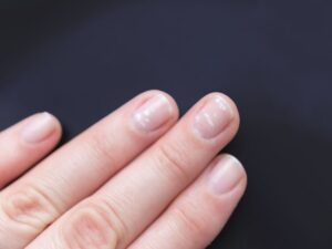 manque de zinc : symptômes