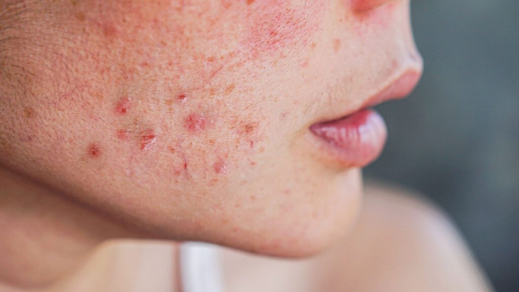 signification bouton visage stress