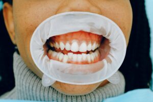 tache blanche sur dent